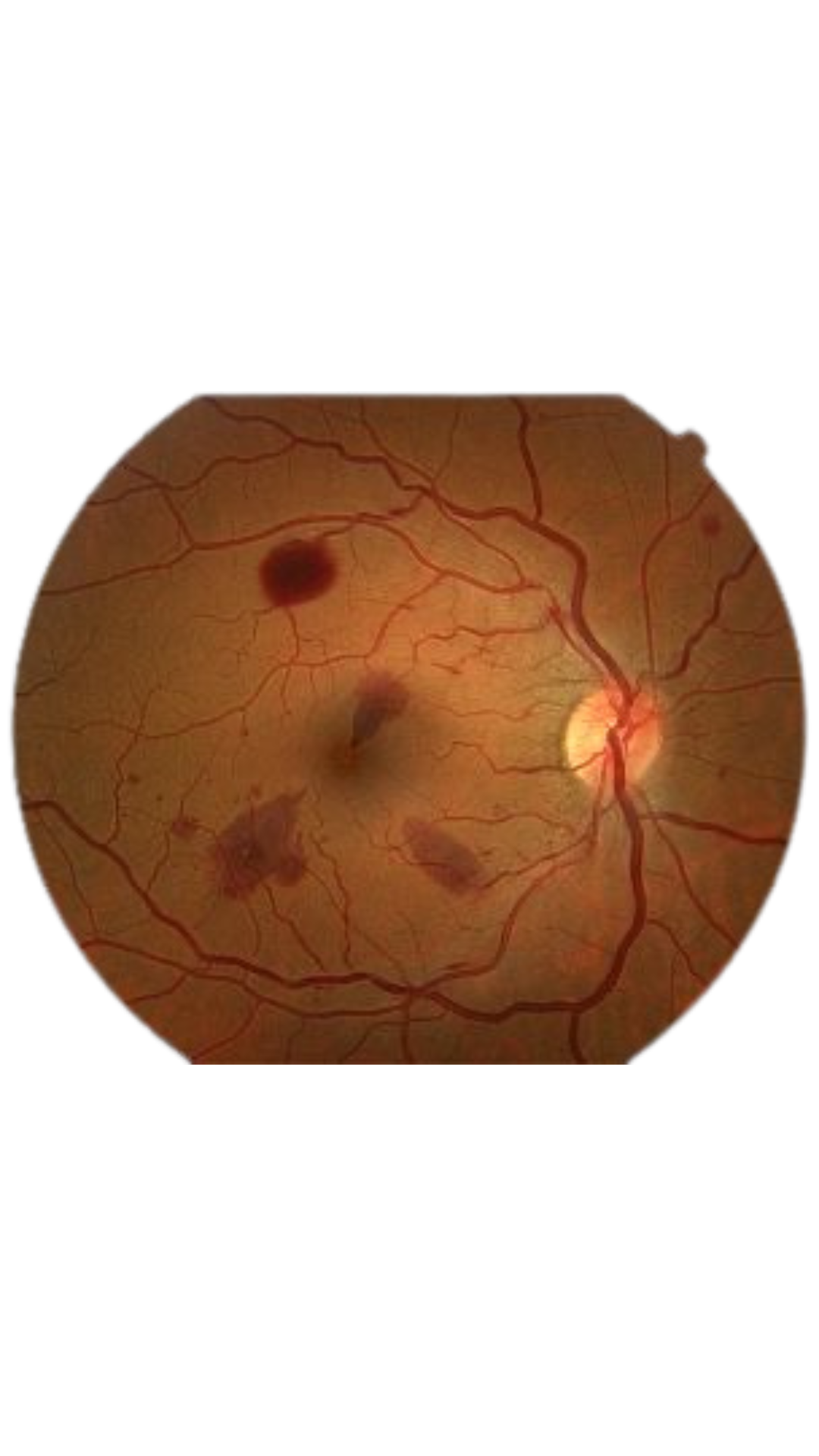 6-KJ-Optometrists-Retina-Examination-Fundus-Evaluation-Diabetic-Retinopathy-Retinal-Camera-Imaging